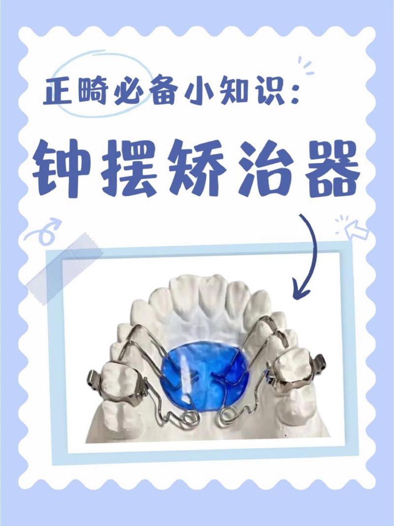 固定矫正期内扩弓方法-图2