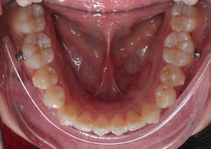 正畸术前口内拍照的标准是什么？规范要点有哪些？-图1