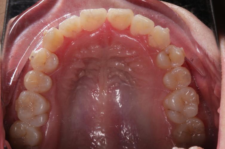 正畸术前口内拍照的标准是什么？规范要点有哪些？-图2