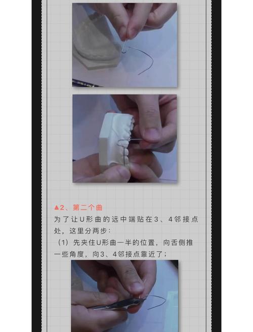 正畸stop曲如何精准弯制？关键步骤与方法解析-图1