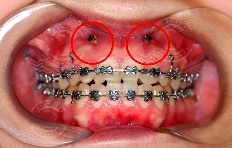 牙齿正畸 不用打钉子吧-图2