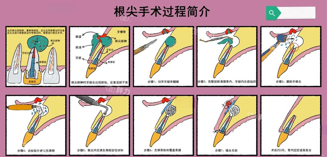 把牙齿变尖最快的方法是什么？安全可行吗？-图2