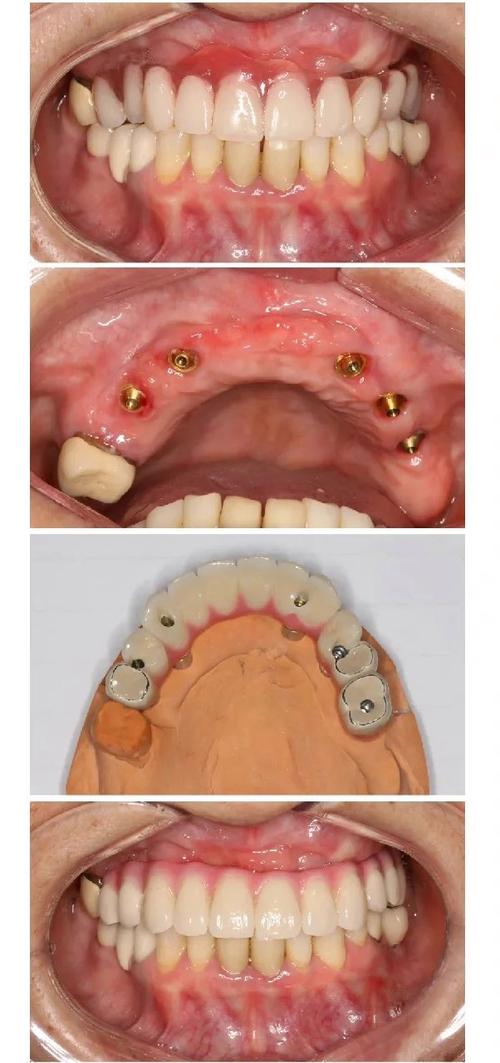 半口种植牙最少需要种几颗?这个数量有最低标准吗?-图1 半口种植牙最少需要种几颗?这个数量有最低标准吗?-图1