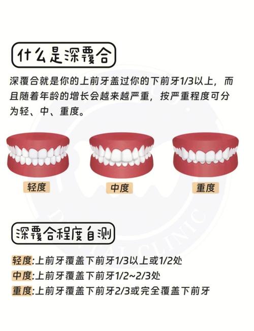 深覆合的修复治疗方法-图1