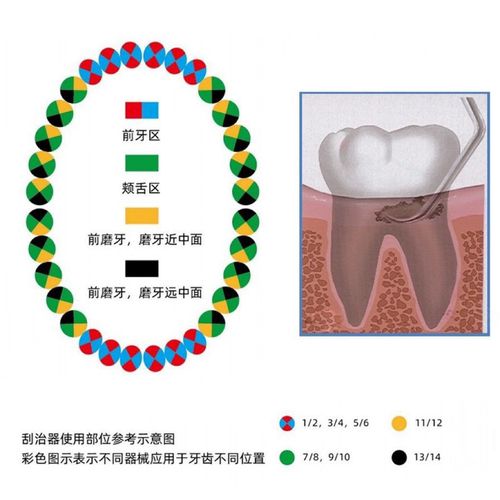 牙科刮治器如何正确使用?操作步骤与技巧有哪些?-图2 牙科刮治器如何正确使用?操作步骤与技巧有哪些?-图2