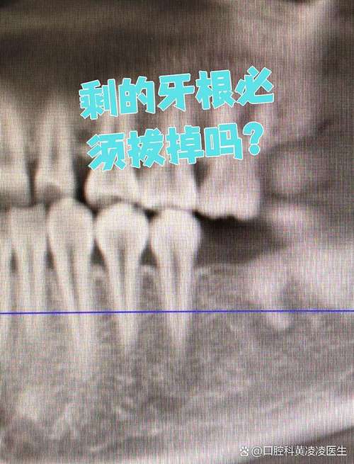 烂牙根只能拔掉种牙吗？还有其他处理方式吗？-图3