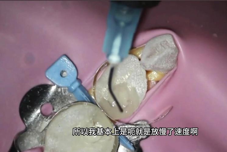 树脂充填器冲洗方法应如何规范操作以达到清洁效果?-图1 树脂充填器冲洗方法应如何规范操作以达到清洁效果?-图1