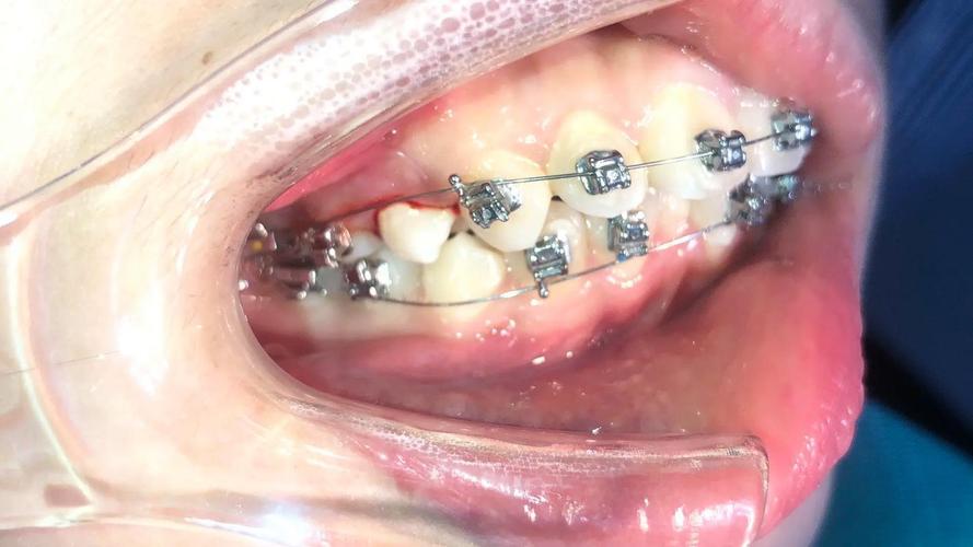 牙齿正畸自锁好还是普通-图1