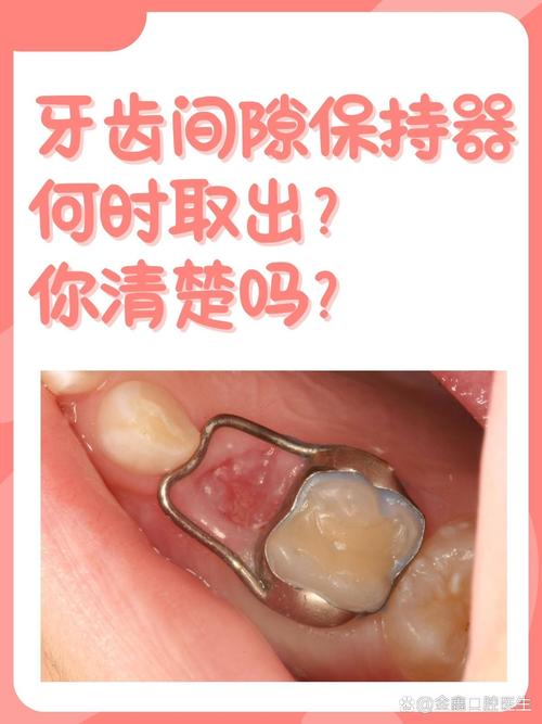 正畸关闭间隙后还要多久完成矫正？-图2