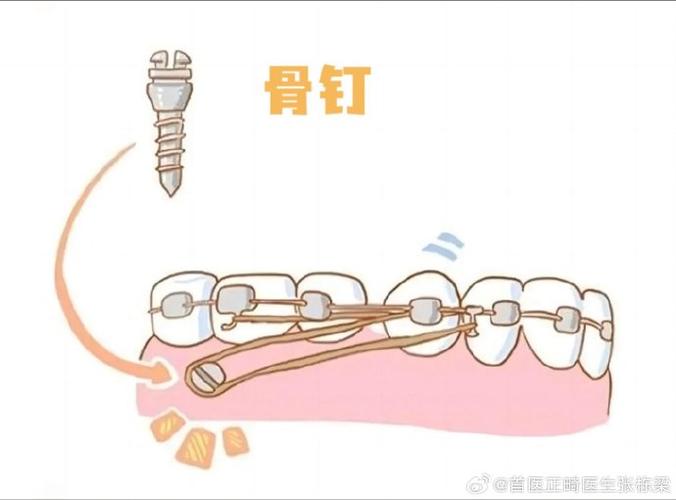 种植钉推磨牙向后方法-图1 种植钉推磨牙向后方法-图1