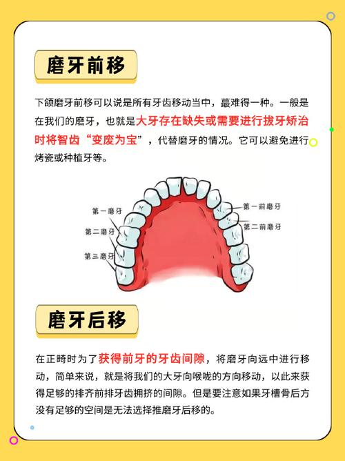 种植钉推磨牙向后方法-图2