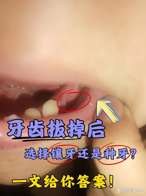 拔牙最迟什么种牙镶牙-图2