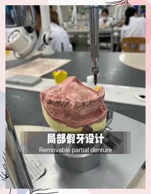 复杂活动义齿取模方法的关键步骤、操作技巧及注意事项有哪些？-图2