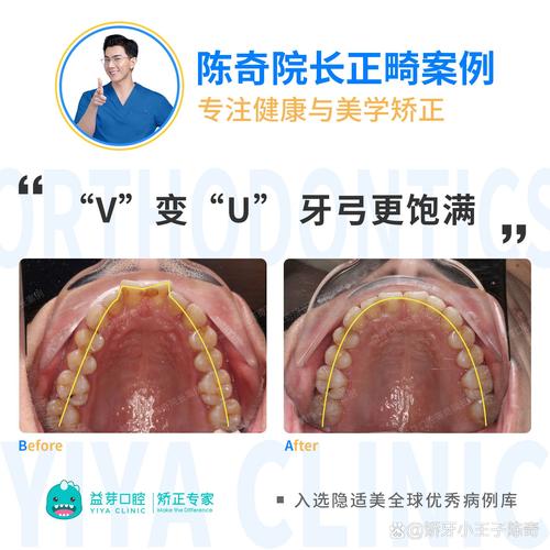 正畸正颌联合治疗医保能报销吗?报销比例和范围如何?-图3 正畸正颌联合治疗医保能报销吗?报销比例和范围如何?-图3