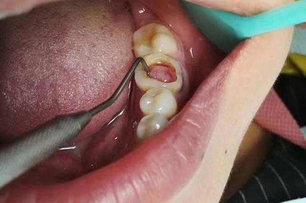 牙齿垫底方法有哪几种-图2 牙齿垫底方法有哪几种-图2