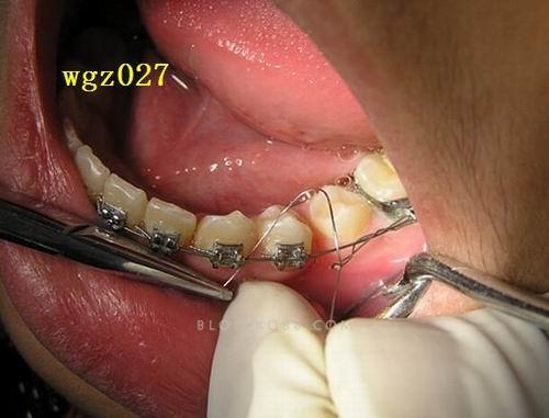 口腔正畸八字结扎方法-图1