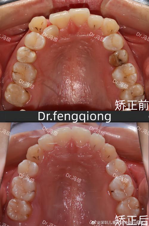 为什么正畸最难移动的就是虎牙？-图3