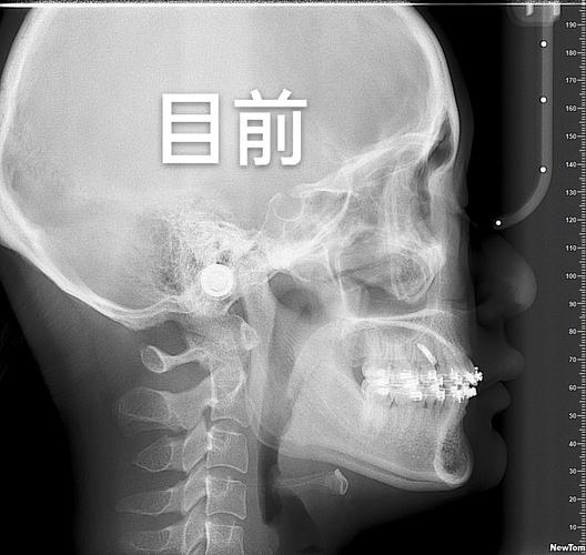拜博口腔正畸技术如何?效果和价格靠谱吗?服务好吗?-图3 拜博口腔正畸技术如何?效果和价格靠谱吗?服务好吗?-图3
