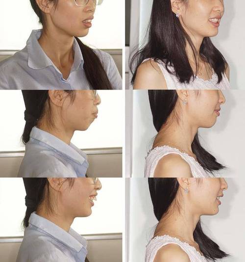 31岁门牙暴牙怎么正畸?成年人矫正还有机会吗?-图3 31岁门牙暴牙怎么正畸?成年人矫正还有机会吗?-图3