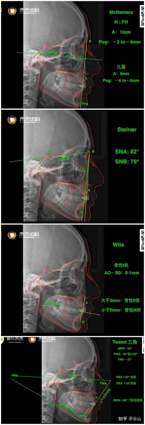 正畸治疗中如何准确测量牙齿所需的间隙？-图2