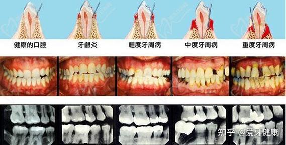 广州免费种牙报名电话-图3
