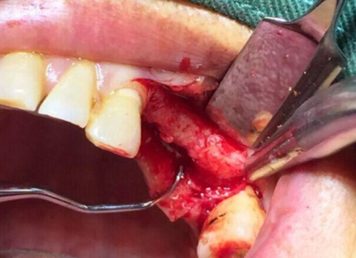 种牙骨高度不足，植骨为何必不可少？-图3