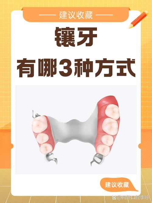 门牙适合镶牙还是种牙-图1