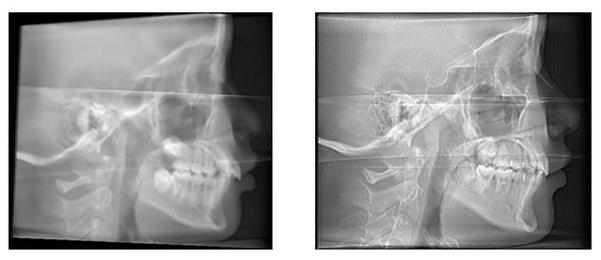 正畸头颅侧位片摆放如何规范?关键步骤有哪些?-图3 正畸头颅侧位片摆放如何规范?关键步骤有哪些?-图3