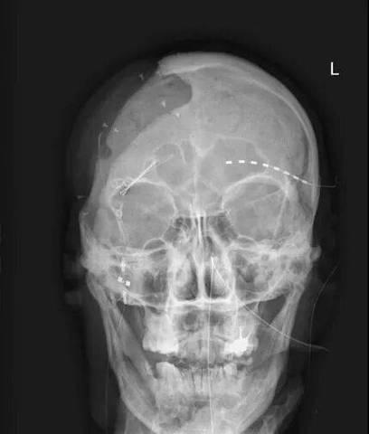 正畸头颅侧位片摆放如何规范？关键步骤有哪些？-图2