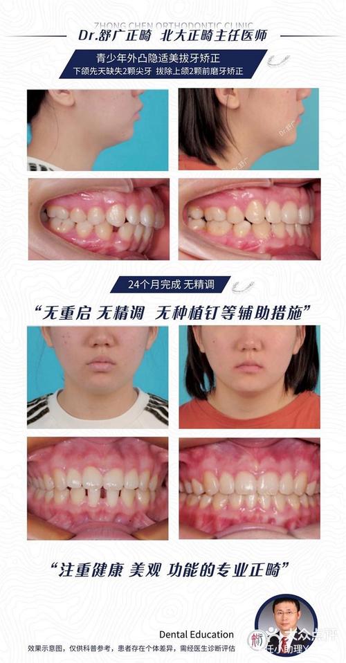 拔牙不种牙，智齿正畸可行吗？会有哪些影响？-图2