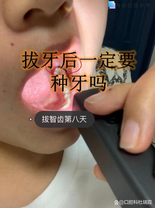 拔牙不种牙，智齿正畸可行吗？会有哪些影响？-图1