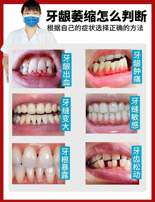 牙龈萎缩有哪些手术治疗方法?-图1 牙龈萎缩有哪些手术治疗方法?-图1