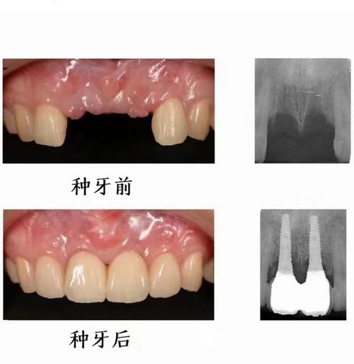 门牙 种植牙可以正畸吗-图1 门牙 种植牙可以正畸吗-图1