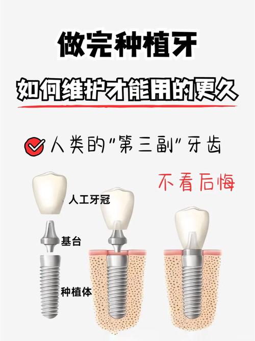 种牙以后怎么长期保养-图3