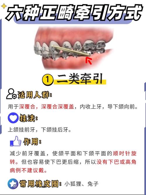 为什么要带口外正畸牵引-图1