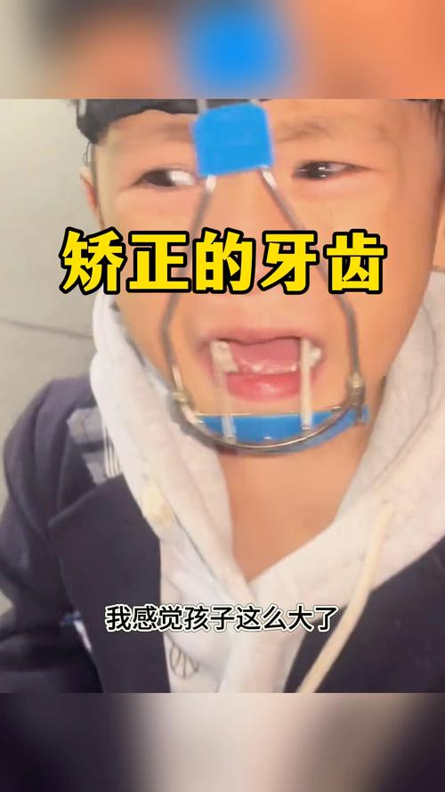 正畸牙齿矫正的过程图片-图2 正畸牙齿矫正的过程图片-图2