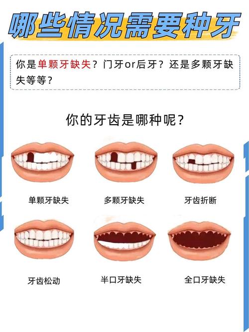 种植牙的治疗方法步骤具体包含哪些关键环节？-图2