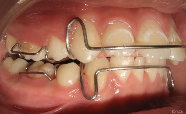 正畸弯单臂卡环教学视频，弯制关键技巧如何快速掌握？-图2