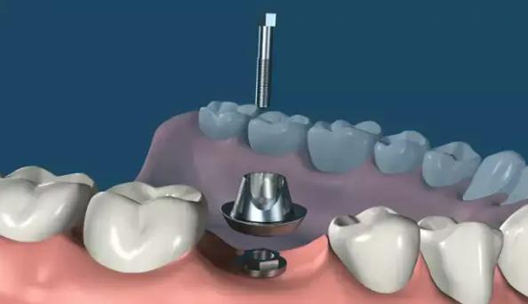 瑞士ITI基台种牙效果怎样？优势需注意哪些？-图2