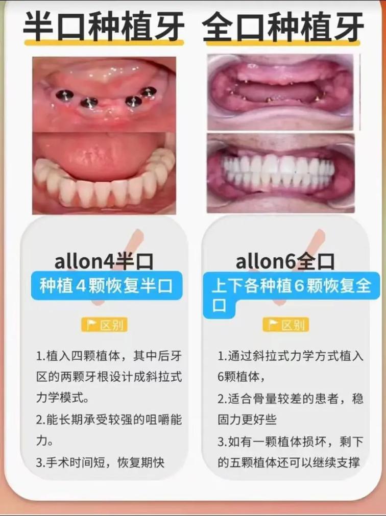 半口牙种植种多少个牙-图2 半口牙种植种多少个牙-图2