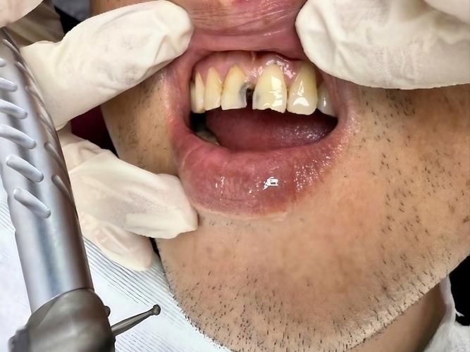 口腔正畸诊室患者的症状-图2