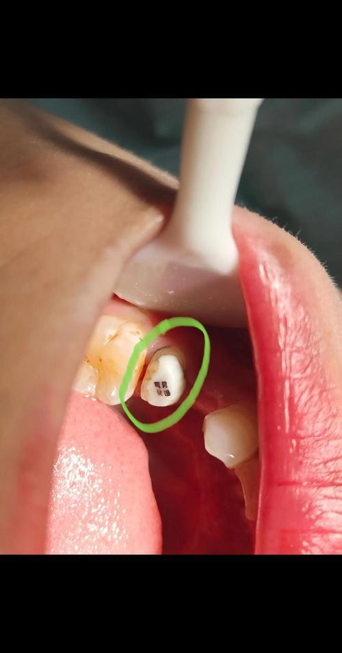 种牙的牙桩究竟是什么样子的？材质、形状、颜色如何？-图2