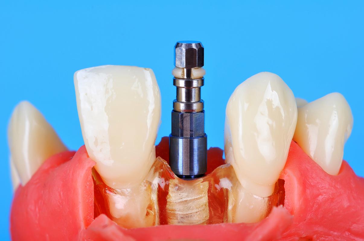 种牙的牙桩究竟是什么样子的？材质、形状、颜色如何？-图3