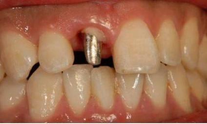 种牙的牙桩究竟是什么样子的？材质、形状、颜色如何？-图1