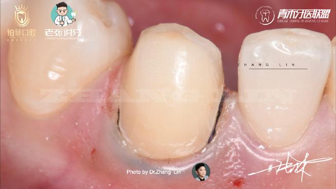 瓷贴面牙体预备方法如何选择与操作以达到最佳效果？-图1