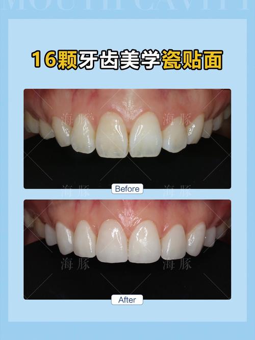 瓷贴面牙体预备方法如何选择与操作以达到最佳效果？-图3