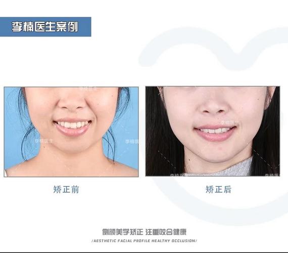 双颌前突手术两种方法有何区别及如何选择?-图2 双颌前突手术两种方法有何区别及如何选择?-图2