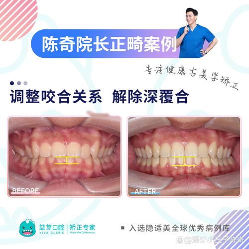 双颌前突手术两种方法有何区别及如何选择?-图1 双颌前突手术两种方法有何区别及如何选择?-图1
