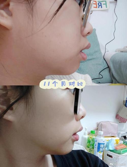 龅牙正畸半年效果对比图，牙齿变化真的有这么明显吗？-图2