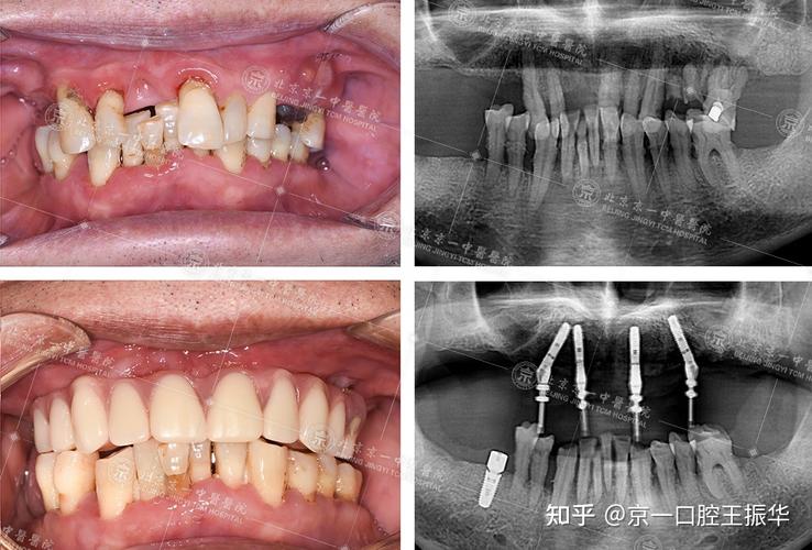 北京种牙哪种比较好？种植体品牌、材料如何选？-图1